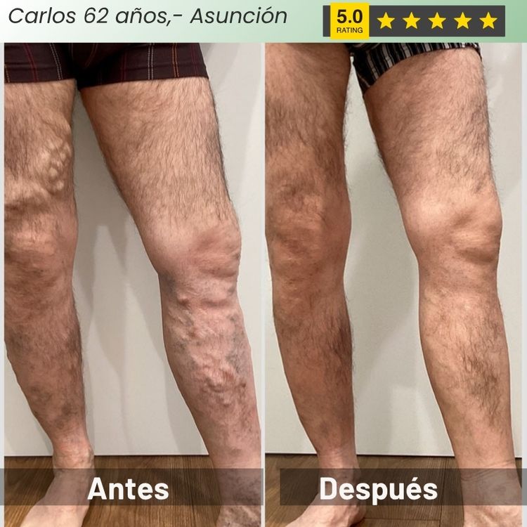 GuanJing® - Tratamiento Natural Eliminador de Varices