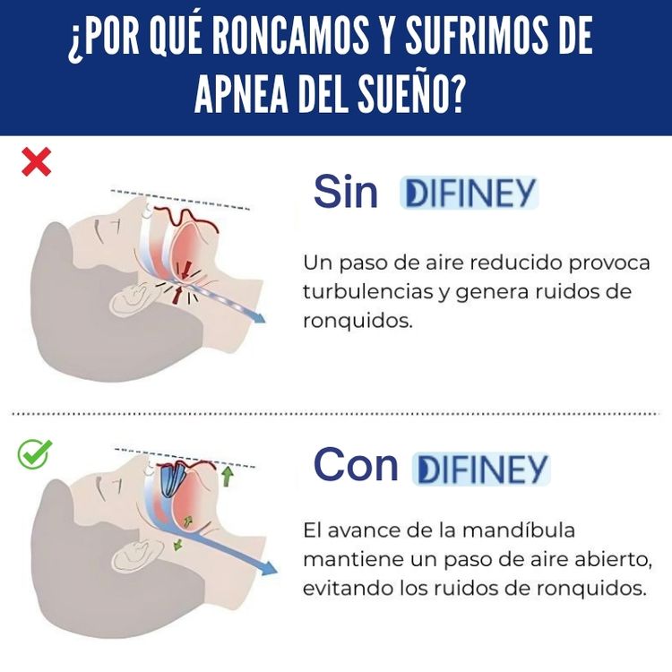 DIFINEY® Antirronquidos Alineador Mandibular