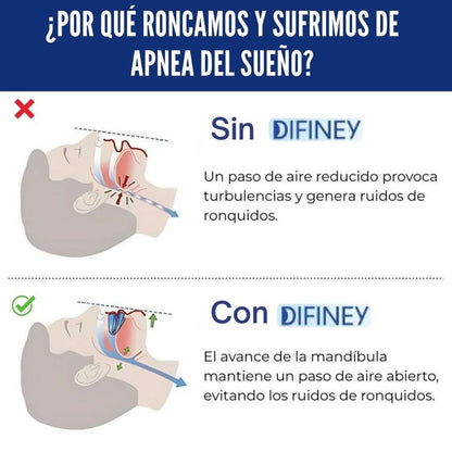 DIFINEY® Antirronquidos Alineador Mandibular